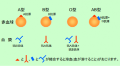 血型不同人的造血干細胞移植